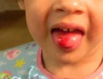 What if a child bites his tongue until it bleeds?